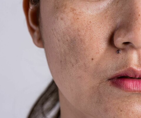 Pigmentflecken-Skin-Effect-Fachinstitut-Kosmetik-Aub-Wuerzburg